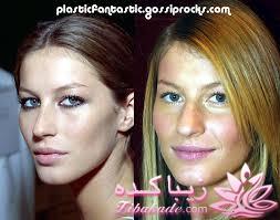 جراحی بینی - جراحی زیبایی